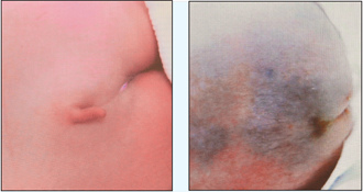 臺(tái)灣一男嬰長(zhǎng)“尾巴”若不手術(shù)恐癱瘓(圖)