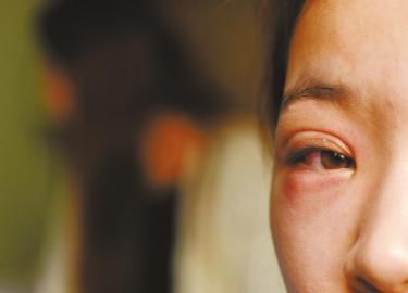 毛毛的一只眼睛受傷紅腫。