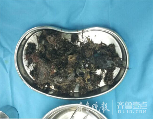 5歲女童愛偷吃頭發 胃里取出大量毛發結石 5歲女童愛偷吃頭發 胃里取出大量毛發結石