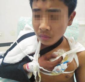 小付的右手傷勢(shì)很重 新文化記者 王躍 攝