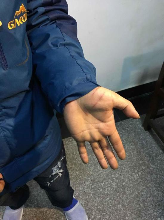 花了6600元沒中彩,江山男子怕老婆罵自割5刀報警稱被搶劫。