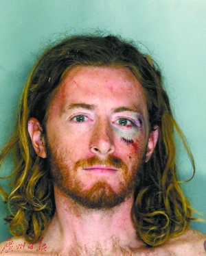 湯姆斯被打后面部縫了9針。